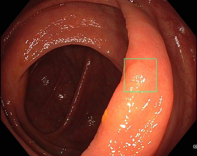 Diesen winzigen Polypen hat das Team der Klinik für Innere Medizin I am St. Elisabethen-Klinikum bei einer Darmspiegelung mit KI-Unterstützung entdeckt.