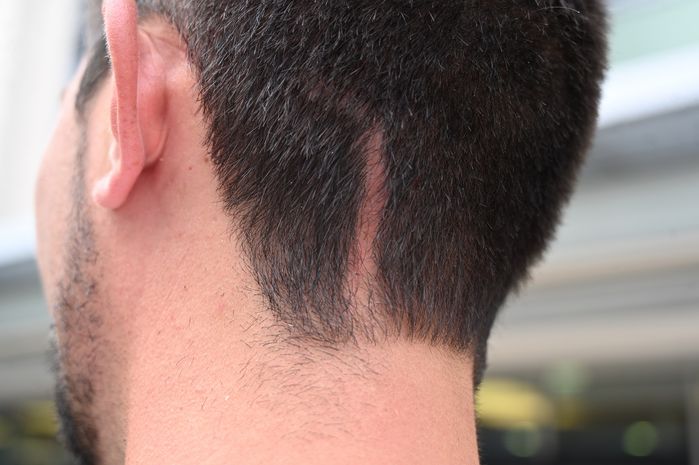 Andenken an den Gehirntumor: Auf der OP-Narbe wachsen keine Haare mehr.